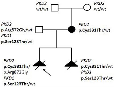 Gene Panel Analysis in a Large Cohort of Patients With Autosomal Dominant Polycystic Kidney Disease Allows the Identification of 80 Potentially Causative Novel Variants and the Characterization of a Complex Genetic Architecture in a Subset of Families